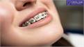 Teeth Veneers vs. Crowns: Choosing the Best Option for Your Smile